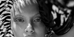 Rihan lives with Alopecia, a condition that causes complete hair loss