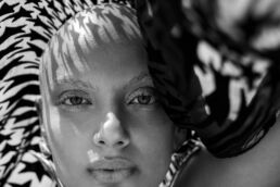 Rihan lives with Alopecia, a condition that causes complete hair loss