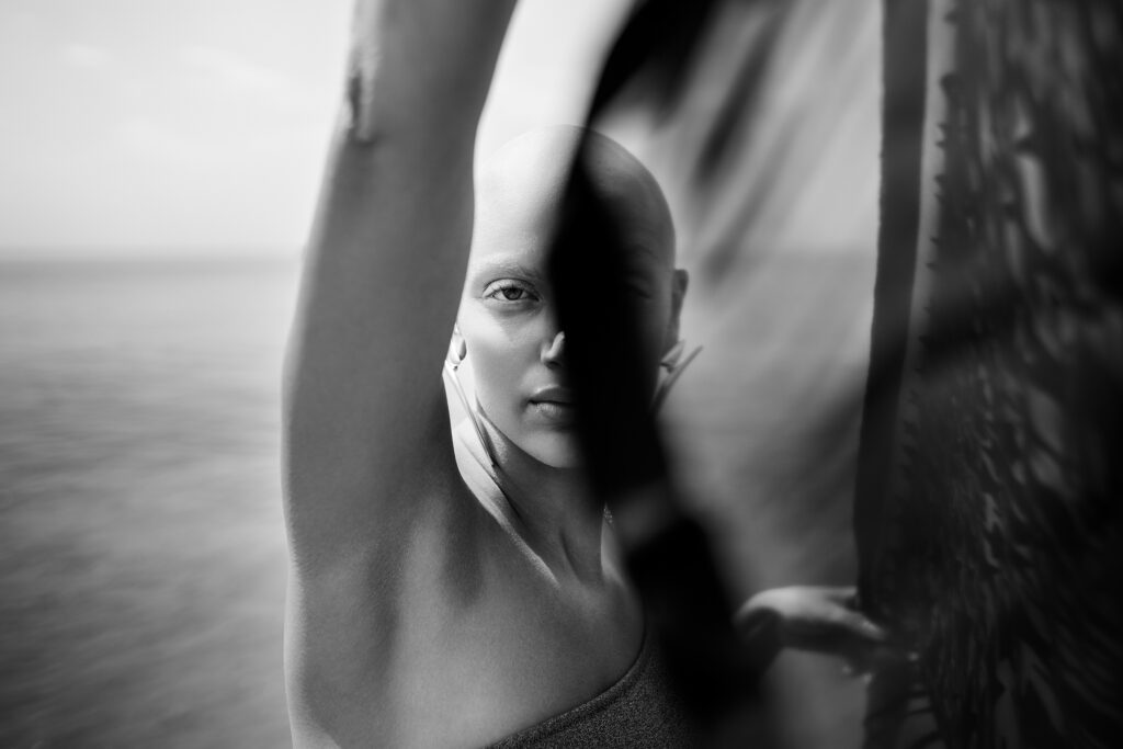 Rihan lives with Alopecia, a condition that causes complete hair loss