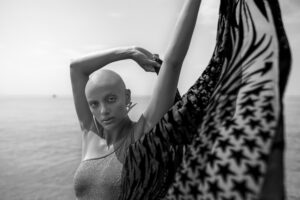 Rihan lives with Alopecia, a condition that causes complete hair loss